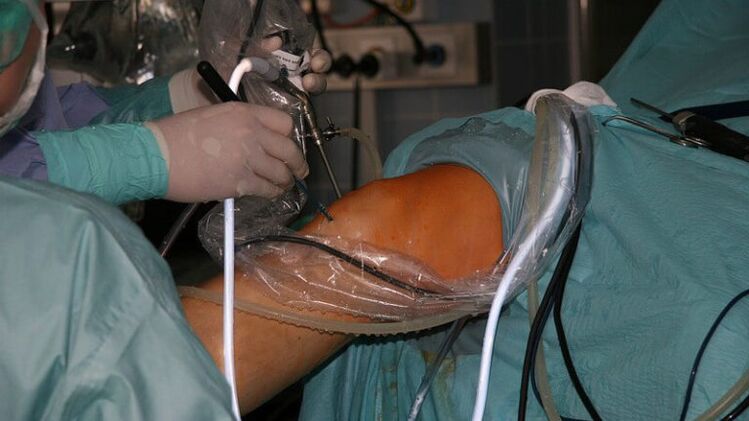 chirurgická léčba artrózy
