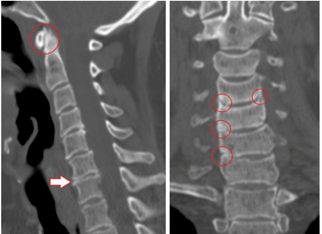 CT sken ukazuje poškozené obratle a ploténky heterogenní výšky v důsledku hrudní osteochondrózy