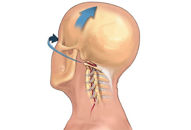 krčení krku při otáčení hlavy jako příznak cervikální osteochondrózy