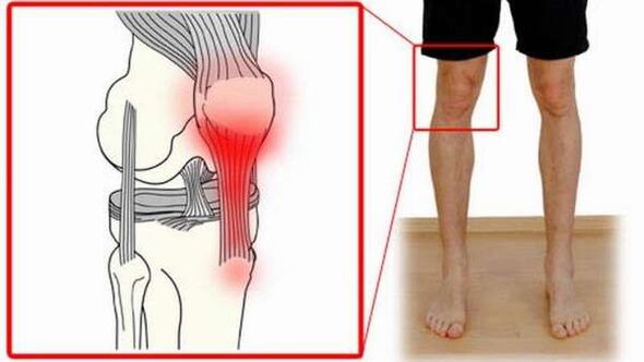 poškození kloubu při artróze ramene