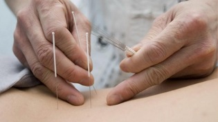 akupunktura pro bederní osteochondrózu