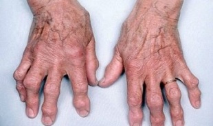 jak rozlišit artritidu prstů od artrózy