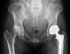 diagnostika artrózy kyčelního kloubu