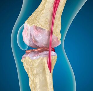 Artróza kolene