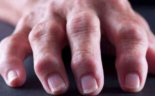 revmatoidní artritida jako příčina bolesti kloubů